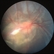 Combined Hamartoma